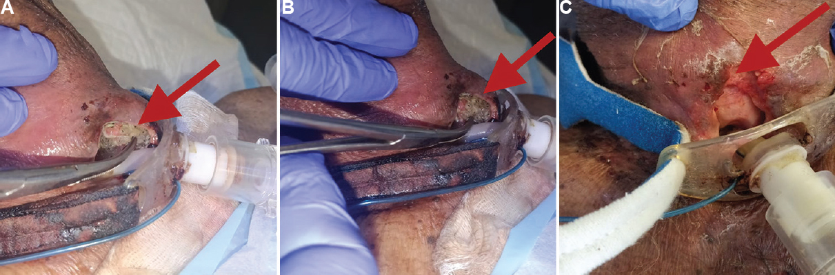 Tracheostomal myiasis: A rare clinical entity